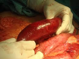 Isquemia intestinal.JPG