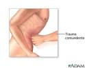 Traumatismos del abdomen.jpg