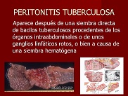 Peritonitis tuberculosa.jpg