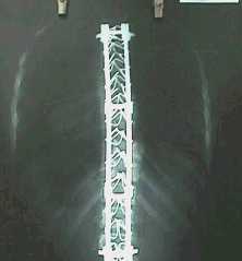 Artrodesis vertebral.jpg