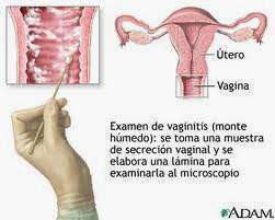 Infección vaginal.jpg