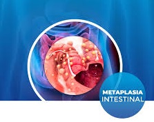 Metaplasia intestinal.jpg