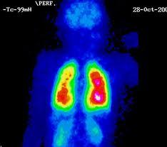 Foto de Gammagrafía pulmonar de perfusión.JPG