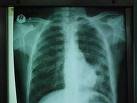 Rx de absceso pulmonar.jpg