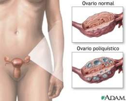 Ovarios poliquisticos.jpg