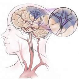 Isquemia cerebral1.jpg