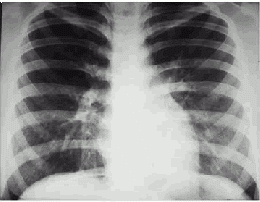 Edema-pulmonar-13f1b.gif