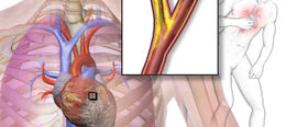 Isquemia cardiaca.jpg
