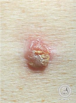 Dermis-Acantoma de celulas claras.jpg