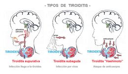 Tiroiditis.jpg