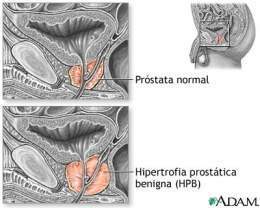 Hiperplasia-prostata.jpg