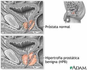 Hiperplasia-prostata.jpg