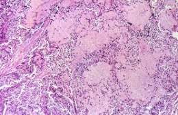 Carcinoma medular.jpg