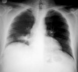 Actinomicosis pulmonar.jpg