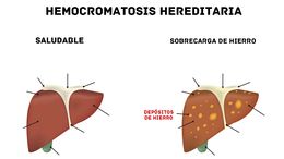 Hemocromatosis.jpg