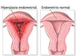 Hiperplasia endometrial.jpg