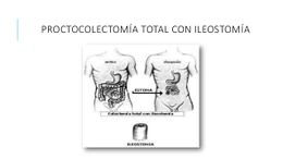 Proctocolectomía Total con Ileostomía Terminal.jpg
