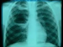 Blastoma pulmonar.jpeg