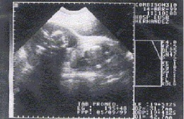 Embarazoheterotópico.JPG